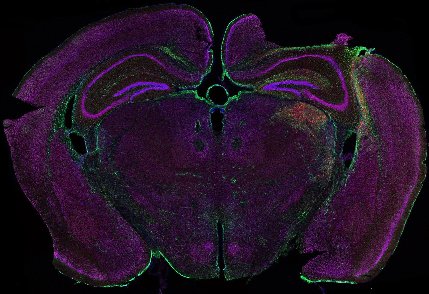 TBI brain image stained for GFAP, Iba1, NeuN, and DAPI